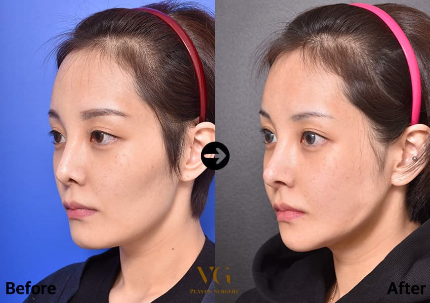 Three-quarter view before and after cheekbone, jaw and chin reduction: a continuous line runs from the ear down to the chin