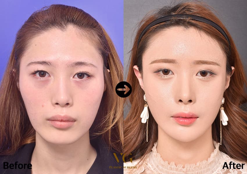 Cheekbone (Zygoma) Reduction — before and after, VG Plastic Surgery