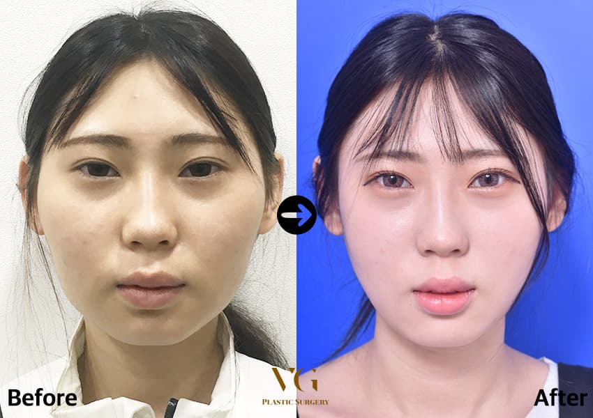 Cheekbone (Zygoma) Reduction — before and after, VG Plastic Surgery