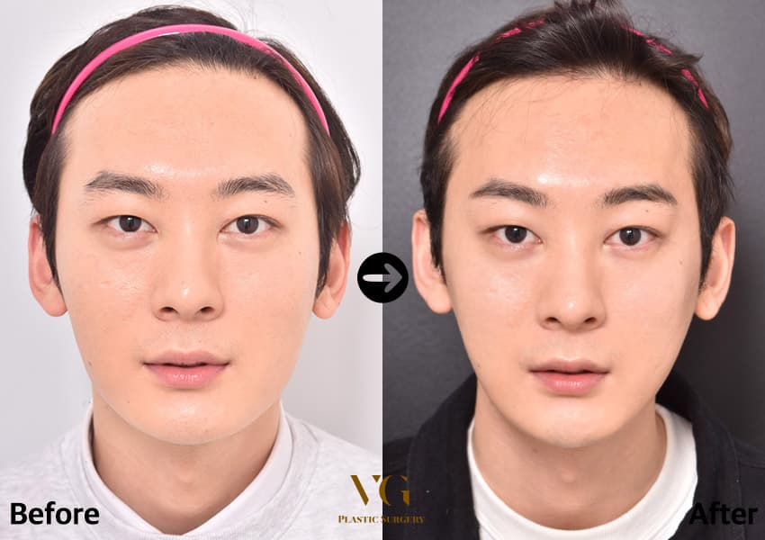 Square Jaw Reduction — before and after, VG Plastic Surgery