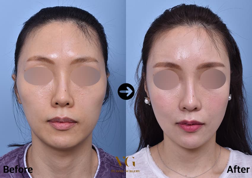 Before and after: Cheekbone (Zygoma) Reduction