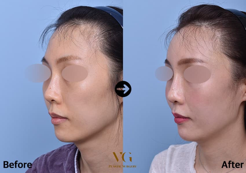 Three-quarter view before and after cheekbone reduction: the bump of the cheekbone in front of the ear is softened