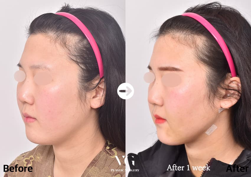 Facial contouring before and after — case 498