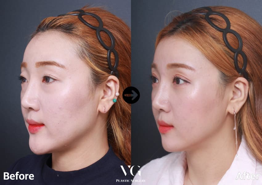 Three-quarter view before and after cheekbone, jaw and chin reduction: the angle below the ear softens into a smooth line toward the chin