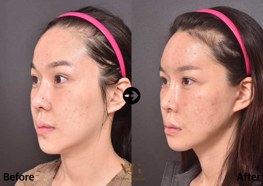 Three-quarter view before and after chin and square jaw reduction: the jaw corner softens and the line runs smoothly to a narrower chin