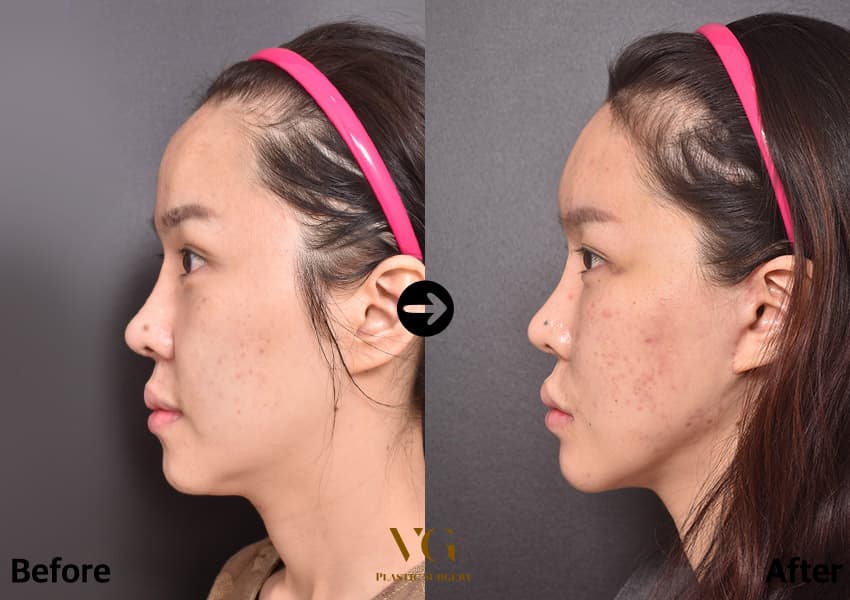 Side view of the same patient before and after: the jaw angle below the ear is reduced and the line toward the chin is smoother