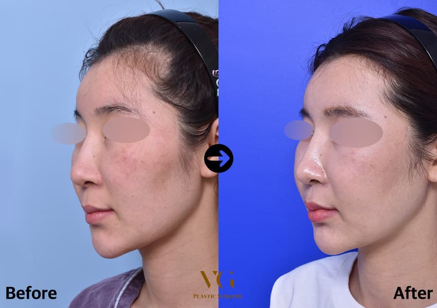 Three-quarter view before and after cheekbone reduction: the cheekbone sits less prominent and the line from cheek to jaw looks smoother