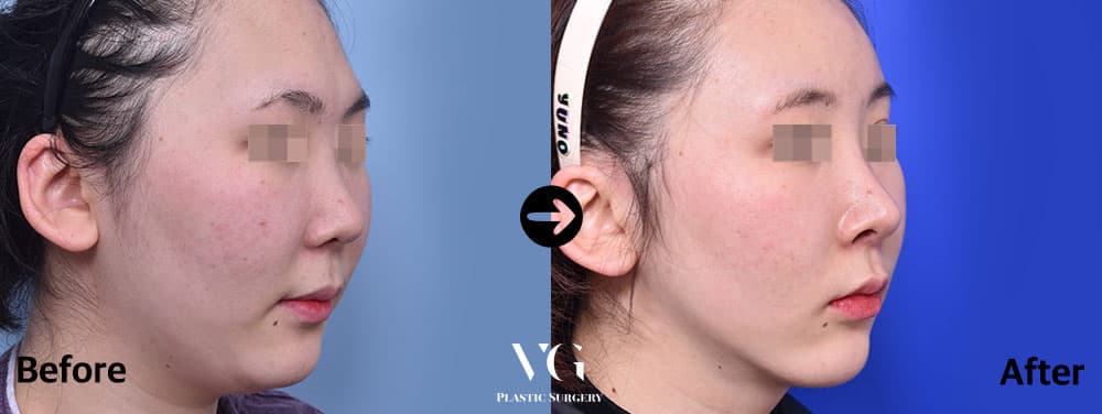 Side view before and after cheekbone reduction with submental liposuction: the cheek looks less prominent and the area under the chin is cleaner