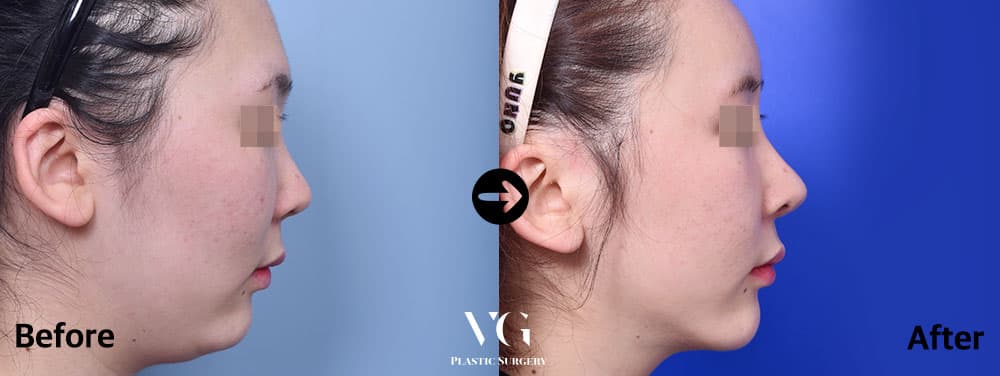 Side profile before and after: the fullness under the chin is gone and the neck line is sharper, on a brighter blue background