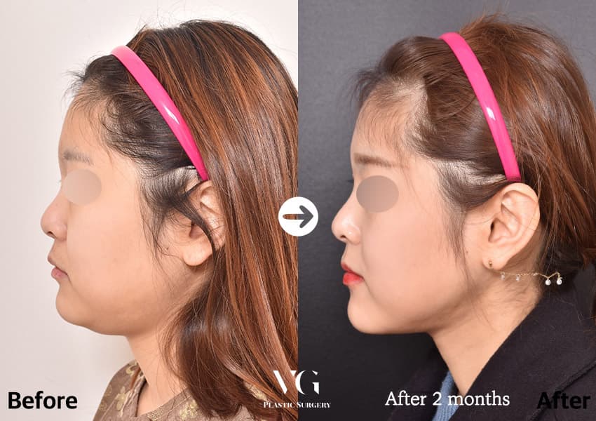 Side profile before and after liposuction under the chin: a soft, rounded neck line on the left, a sharper angle from chin to neck on the right