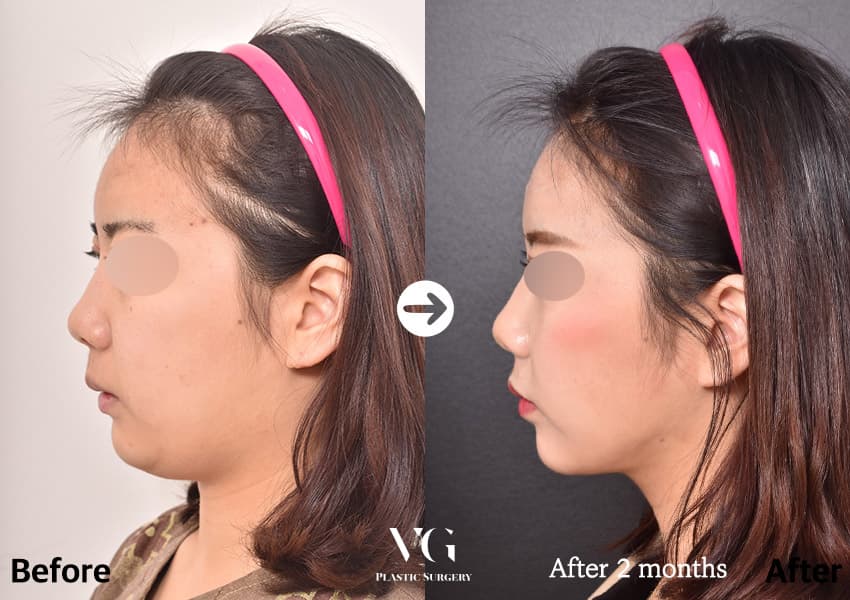 Side profile before and after chin and jawline liposuction: a rounded fold under the chin becomes a defined angle to the neck