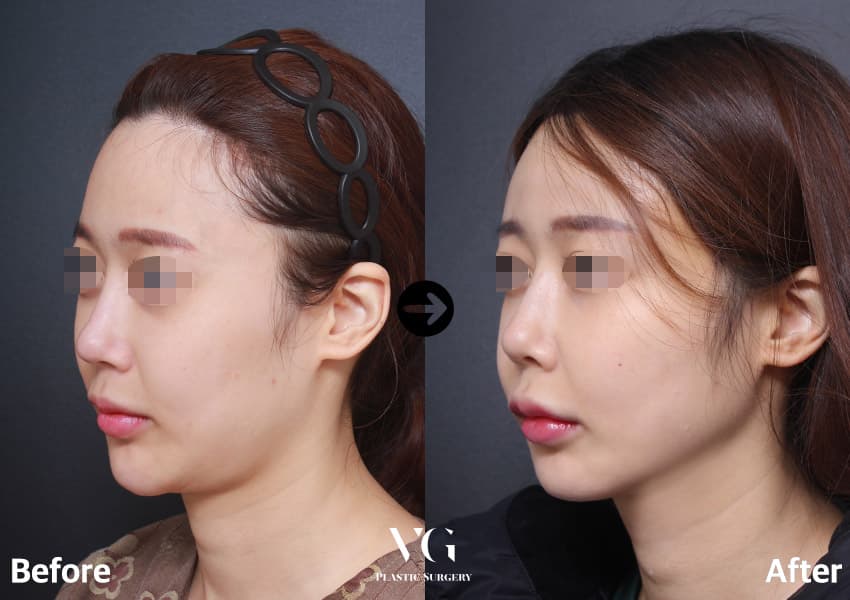 이중턱 지방흡입 + 턱선 지방흡입 — 각도 1