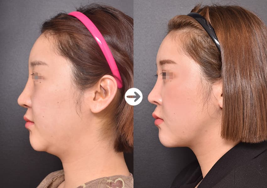 Side profile before and after liposuction of the chin and jaw: a full curve under the chin changes to a straighter neck line
