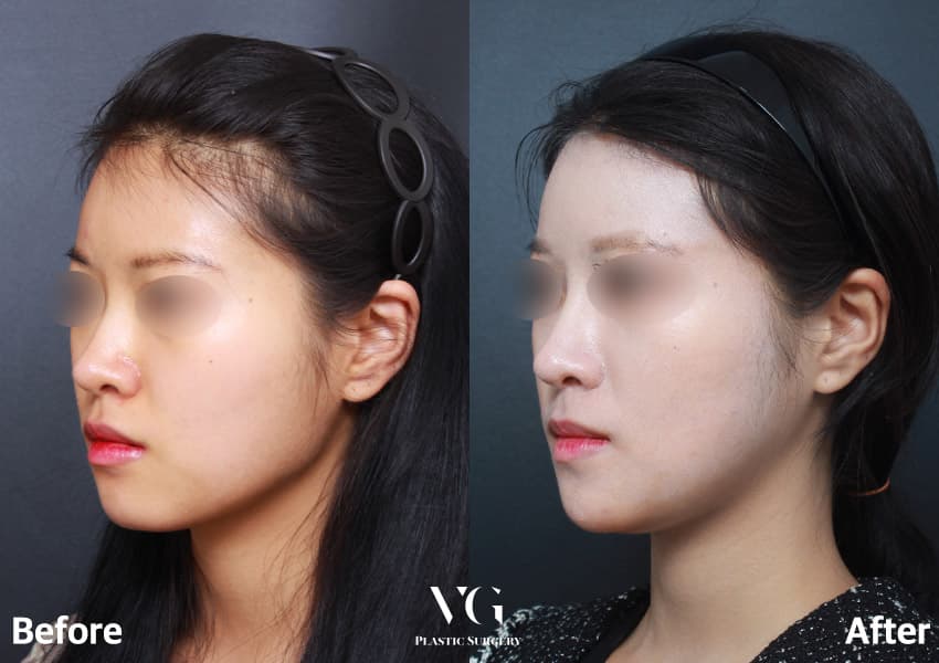 Three-quarter view before and after long-curve jaw reduction: the lower border of the jaw now runs in one smooth line from ear to chin