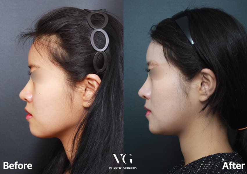 ภาพด้านข้างก่อนและหลังผ่าตัดกรามแบบแนวโค้งยาวของผู้ป่วยหญิง หลังผ่าตัด 3 เดือนเส้นขากรรไกรล่างเรียวและต่อเนื่องขึ้น