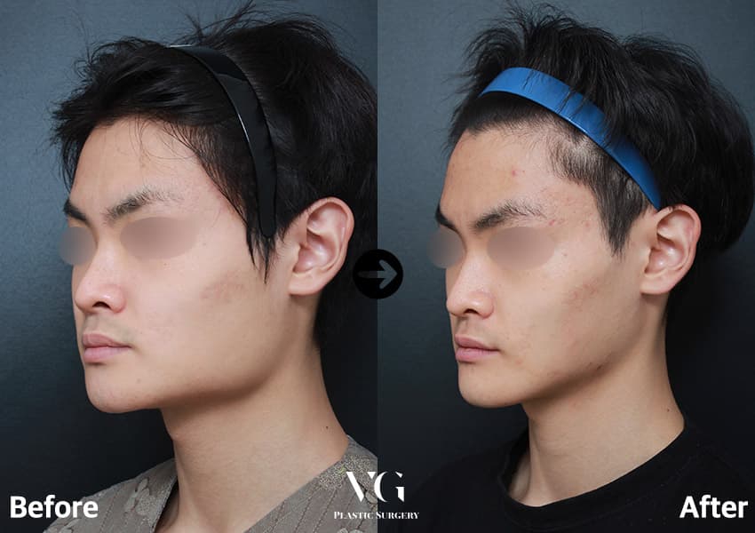 Three-quarter view before and after square jaw reduction: the sharp corner below the ear is replaced by a smoother, sloping jawline