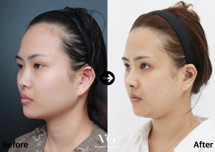 Three-quarter view on a dark background before and a white one after: the line from cheekbone to chin is shorter and narrower