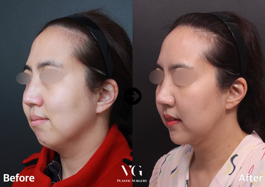 Side view before and after chin advancement with double chin liposuction: the chin sits further forward and the neckline is cleaner
