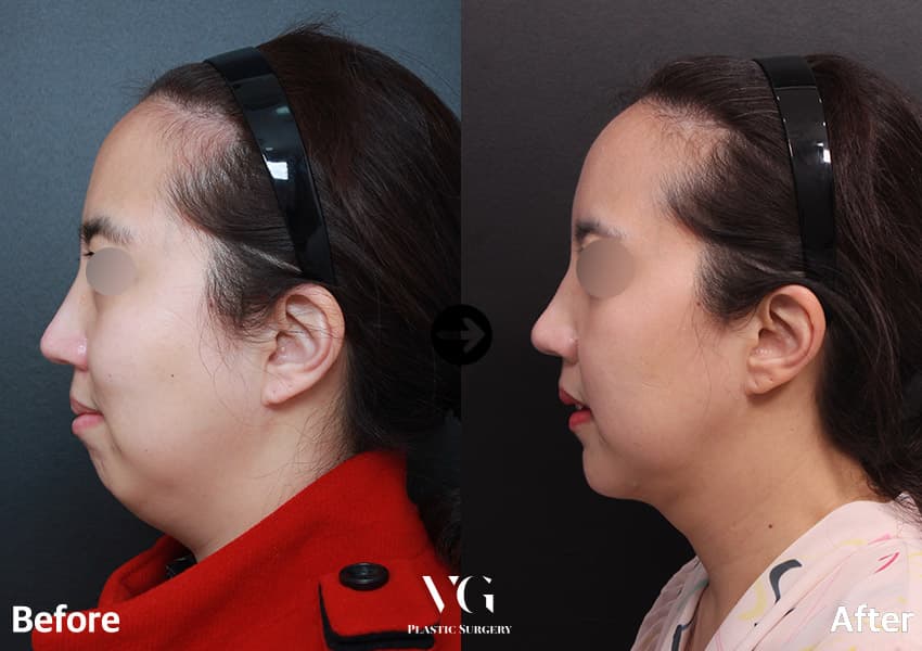 下巴前移加雙下巴抽脂術前術後側面(眼部遮蔽):術前下巴後縮且下巴底下脂肪多,術後 3 個月下巴與頸部之間出現轉折