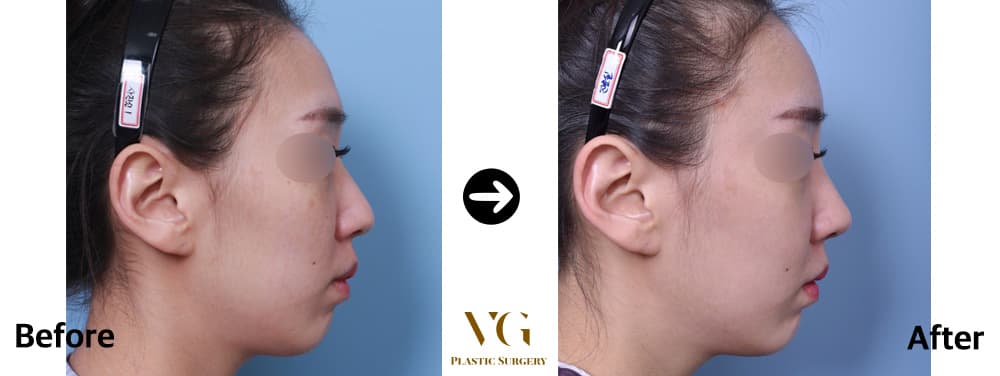 顔全体の脂肪移植を受けた女性の横顔の術前術後。右では額のカーブがなめらかになり、頬の平らな部分にふくらみが出ている
