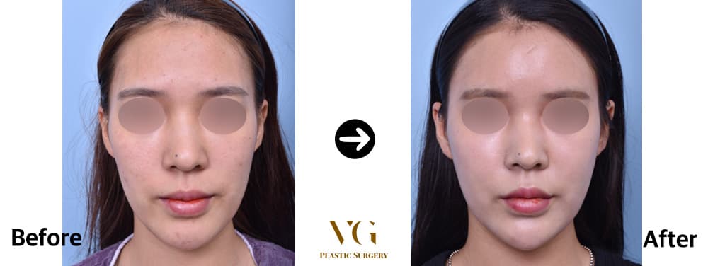 Before and after: Fat Grafting