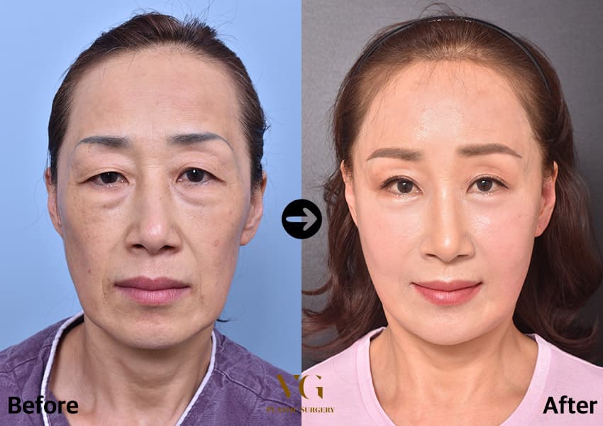 Fat grafting before and after — case 494