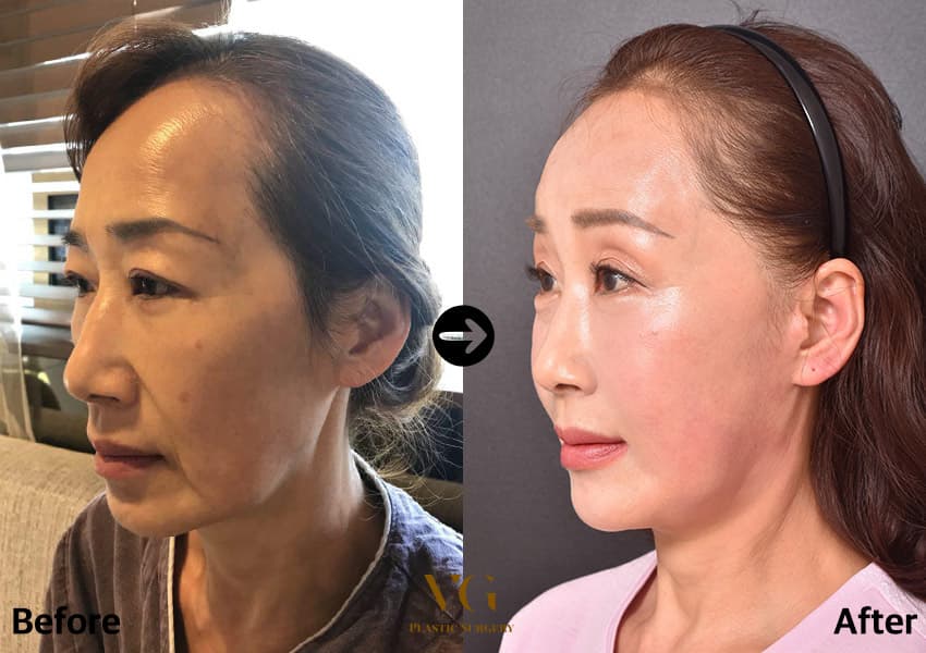 Three-quarter view of the same case: the brow sits higher above the eye, the lid is lighter and the cheek and jawline are lifted