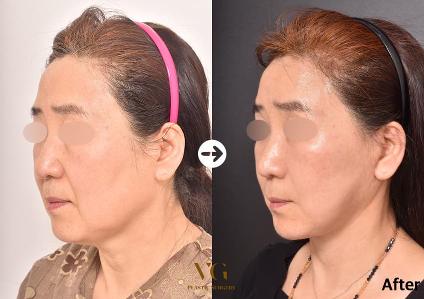 Three-quarter view before and after a full-face facelift: the cheek and jowl sit higher and the skin under the jaw is tighter