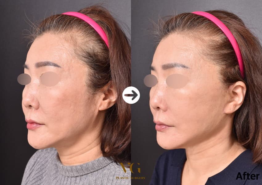 Three-quarter view before and after a full-face facelift: the loose cheek and jowl are drawn up and the line from jaw to neck is cleaner
