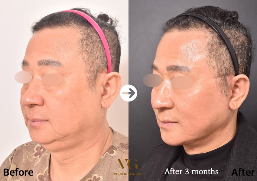 全臉拉皮術前術後 45 度側臉:術前下顎下方與頸部交界鬆垂,術後下顎線到頸部的角度變得清楚