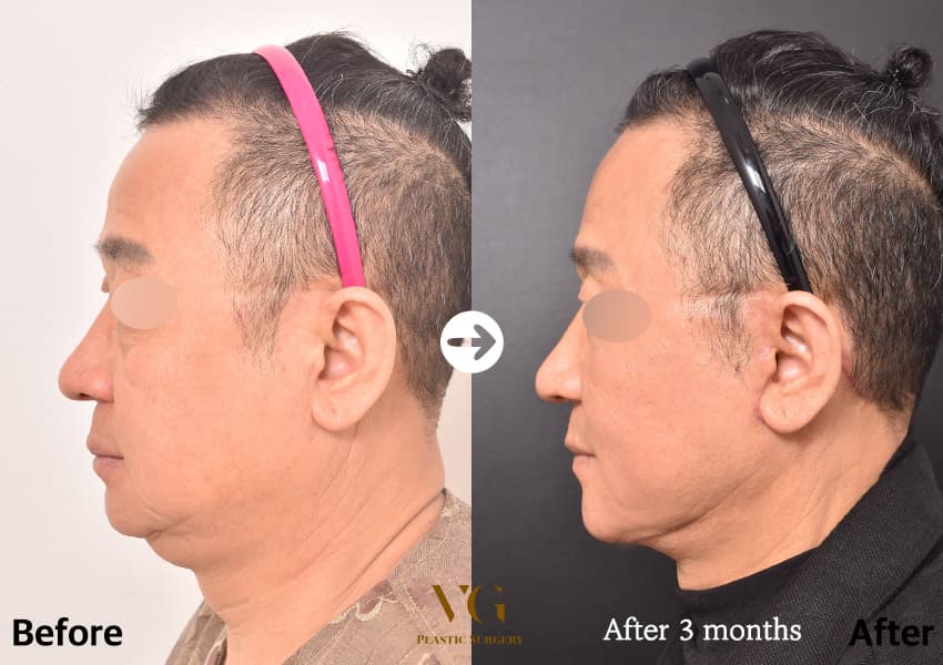 Side profile of a man before and after a full-face facelift: the sagging under the jaw is lifted and the jaw-to-neck angle reads more clearly