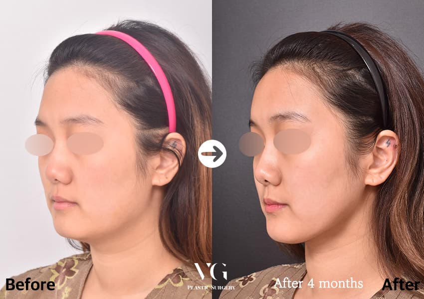 Fat grafting before and after — case 501