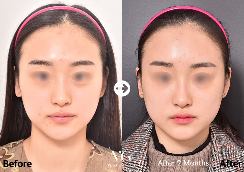 Front view before and after full-face fat grafting: flat forehead and hollow temples on the left, a rounder forehead and fuller cheeks on the right