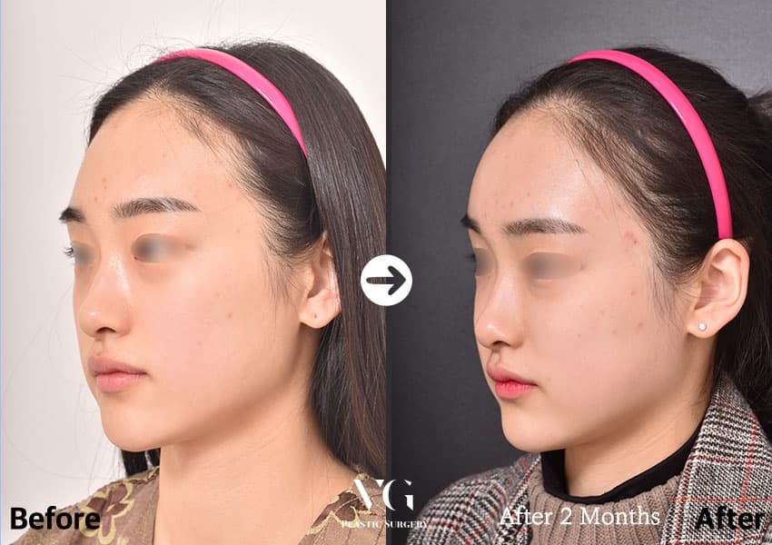 Three-quarter view before and after full-face fat grafting: the flat forehead and sunken temple are filled and the forehead curve is smoother