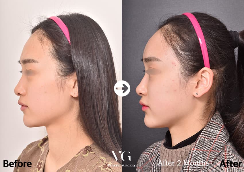 Profile before and after full-face fat grafting: the forehead line runs in a softer curve into the brow and the cheek looks fuller
