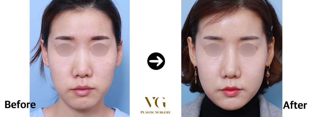 Before and after: Fat Grafting