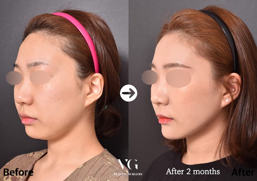 Before and after: Double-Chin Liposuction + Buccal Fat Liposuction + Chin Fat Grafting