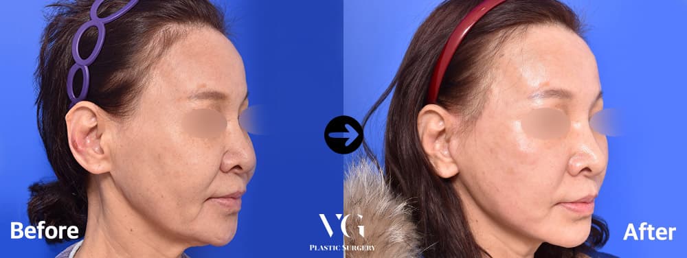 Three-quarter view before and after a full-face facelift: the loose skin along the jaw and under the chin is drawn up and the jawline is clearer