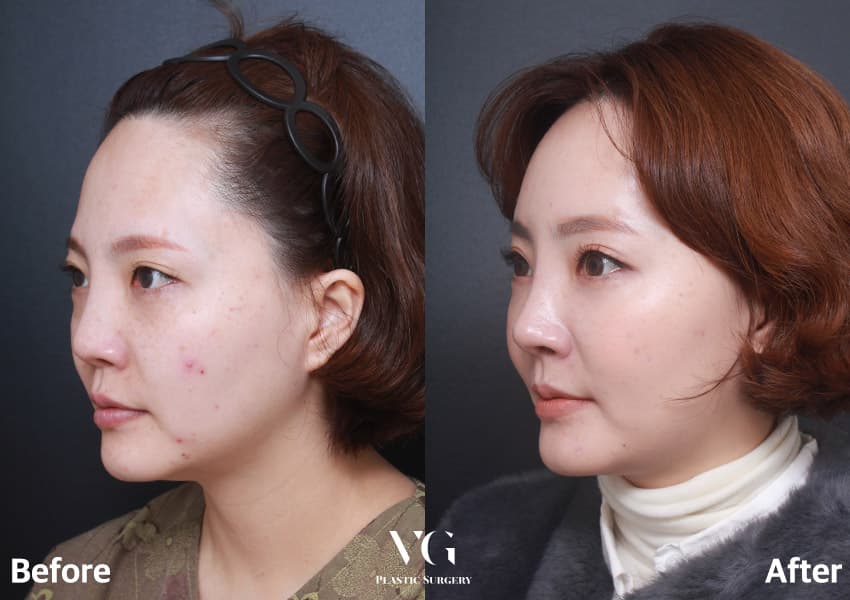 코 재수술 + 자가늑연골 + 이마거상술 +1