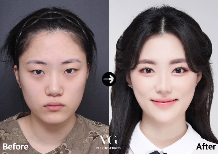 자연유착 쌍꺼풀 + 앞트임 + 듀얼트임 +2