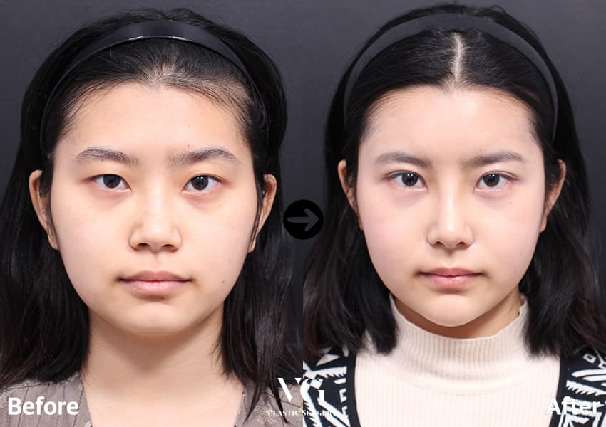自然癒着二重 + 鼻整形 + 小鼻縮小 +3