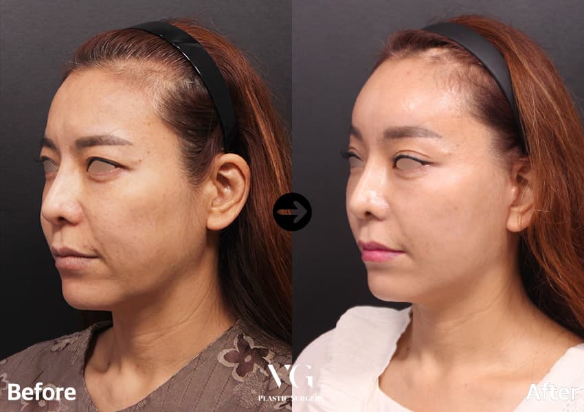 Three-quarter view before and after a full-face lift with forehead lift: the heavy lower cheek and jowl are raised and the brow sits higher