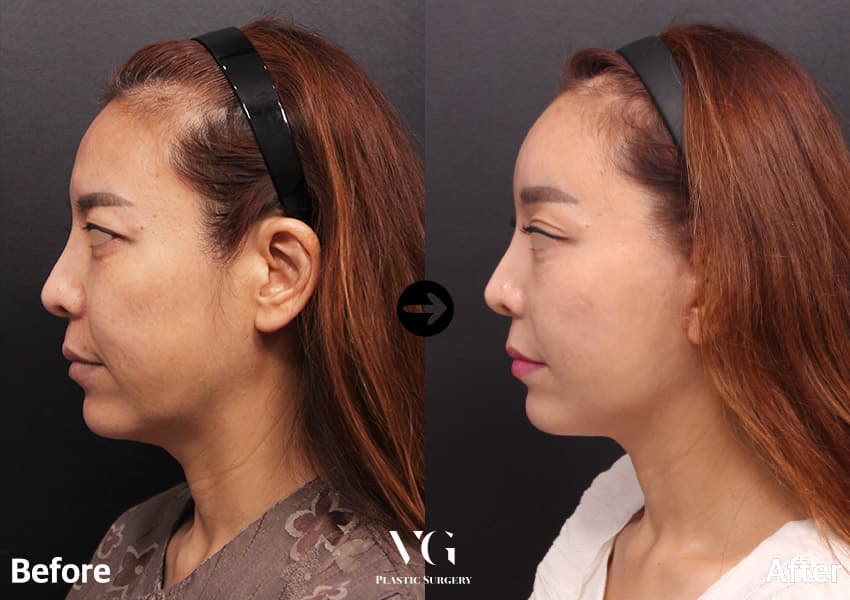Profile before and after a forehead lift with full-face facelift: the brow and outer eye corner sit higher and the jawline is firmer
