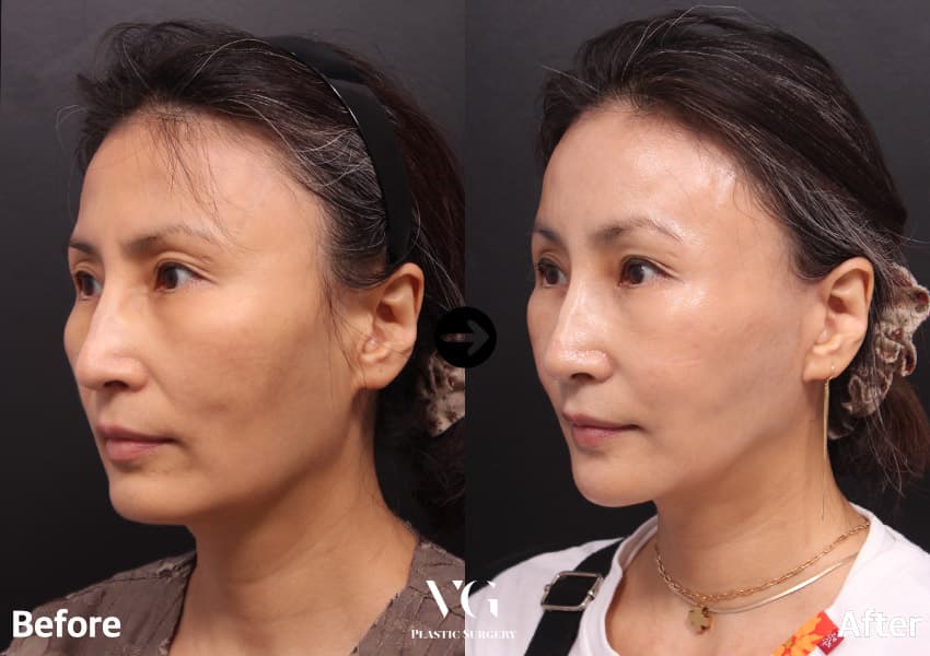 Chin Reduction, Chin Advancement example case at VG Plastic Surgery, 3 months after surgery, from the consented case archive