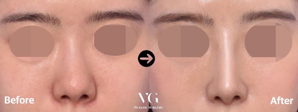 ตัวอย่างเคสเสริมจมูกที่ VERYGOOD Plastic Surgery (หลังผ่าตัด 3 เดือน) จากคลังเคสที่ได้รับความยินยอม