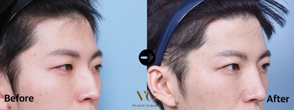 코성형 전후 비교 · 케이스 460