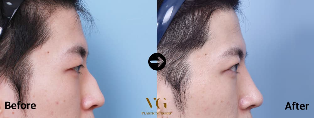 Side profile of a man before and after hump correction: the bump on the bridge is removed and the line runs straight to the tip