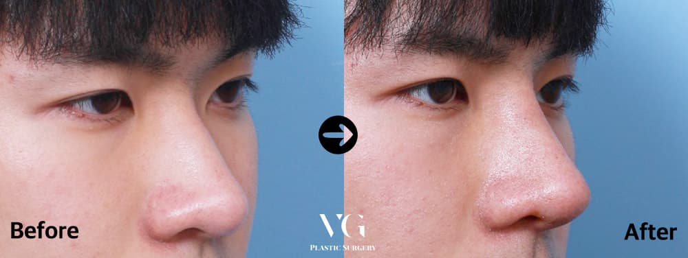 코성형 전후 비교 · 케이스 462