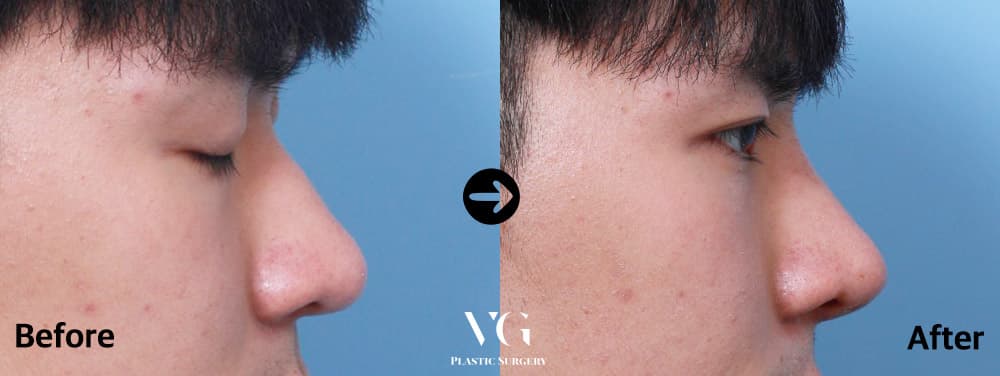 ภาพด้านข้างผู้ชายก่อนและหลังเสริมจมูก 3 เดือน สันจมูกระหว่างดวงตาสูงขึ้นเป็นเส้นตรง ปลายจมูกไม่เชิดขึ้น