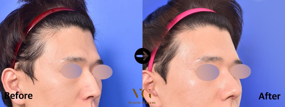 남자 코성형